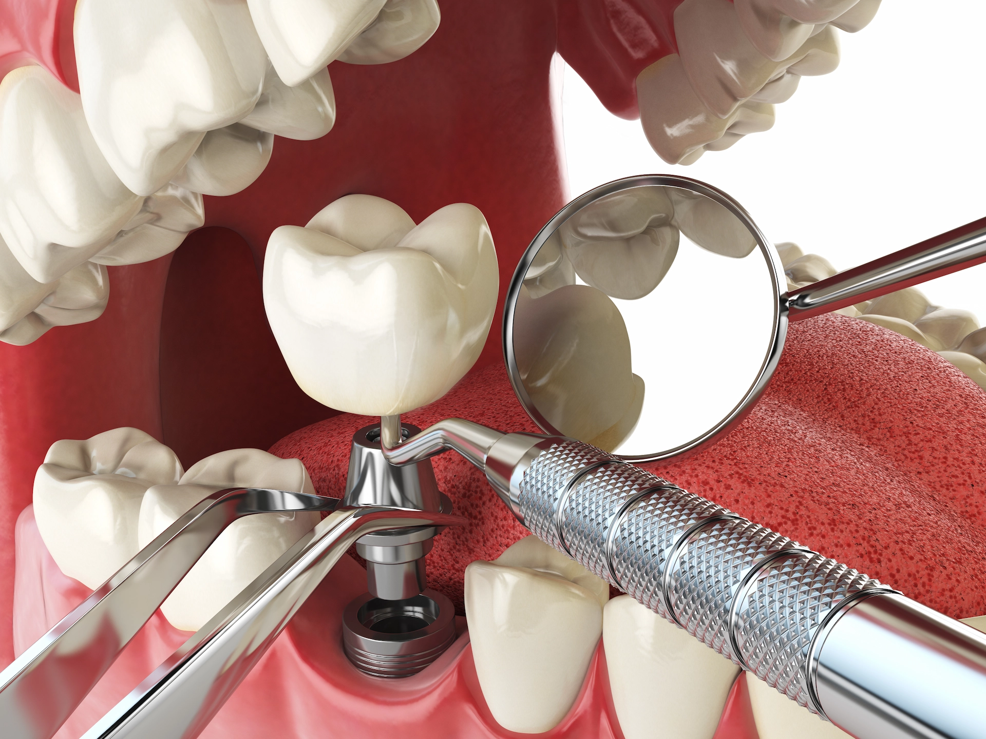 Dental Implants